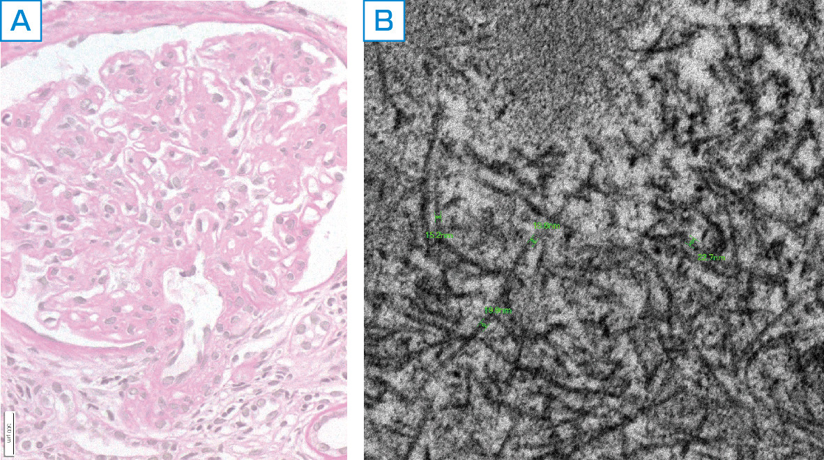 ⓔ図14-6-5　細線維性糸球体腎炎の腎臓病理所見 A：膜性増殖性糸球体腎炎様病変 (PAS染色，×400)． B：不特定に配列する細線維構造 (電子顕微鏡，×2万)．