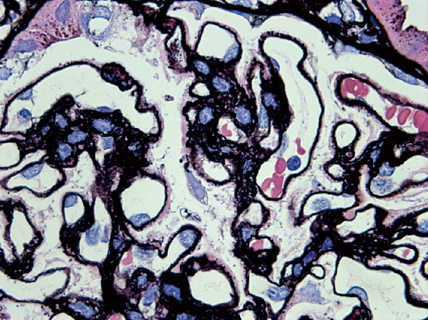 ⓔ図14-6-7　B型肝炎に伴う膜性腎症の光学顕微像 上皮下沈着とスパイク形成を認める (PAM染色，1000倍)．