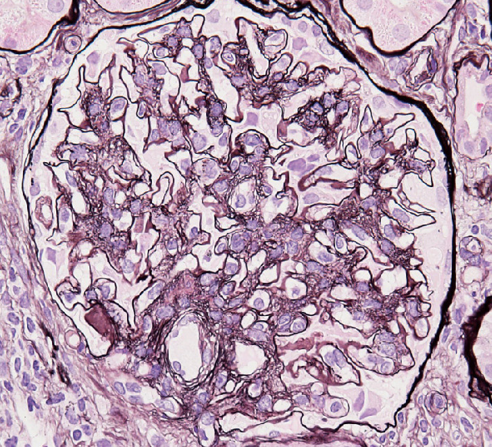 ⓔ図14-6-9　C型肝炎に伴う膜性増殖性腎炎の光学顕微像 (今澤俊之博士提供) メサンギウム細胞の増殖と基底膜の二重化を認める．