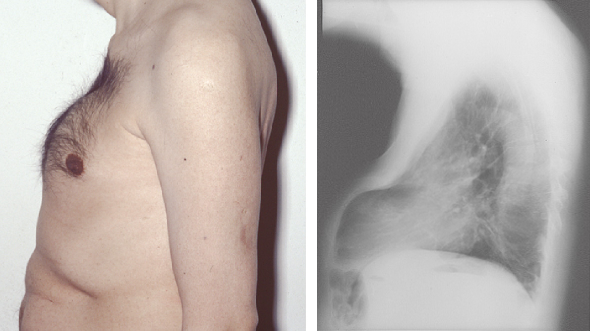 ⓔ図15-17-1　腫瘍性骨軟化症患者の胸郭変形 