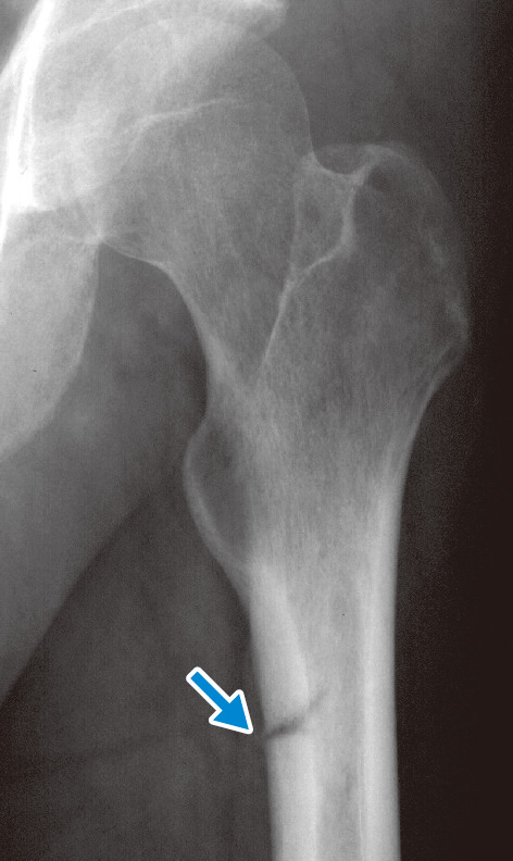ⓔ図15-17-2　腫瘍性骨軟化症患者のLooser’s zone 大腿骨内側，長軸方向にほぼ直交する透亮像が認められる．