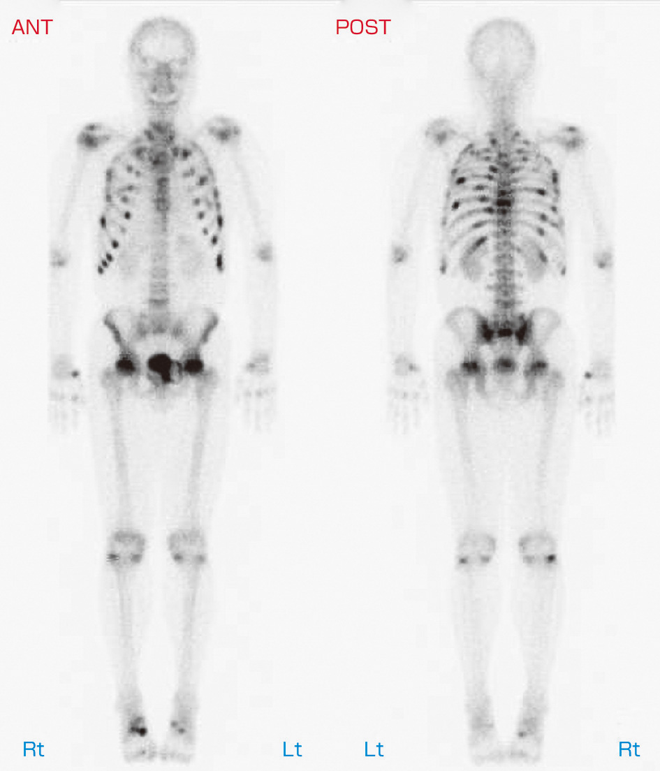 ⓔ図15-17-3　腫瘍性骨軟化症患者の骨シンチグラフィ 肋軟骨などに多発の取り込みが認められる．