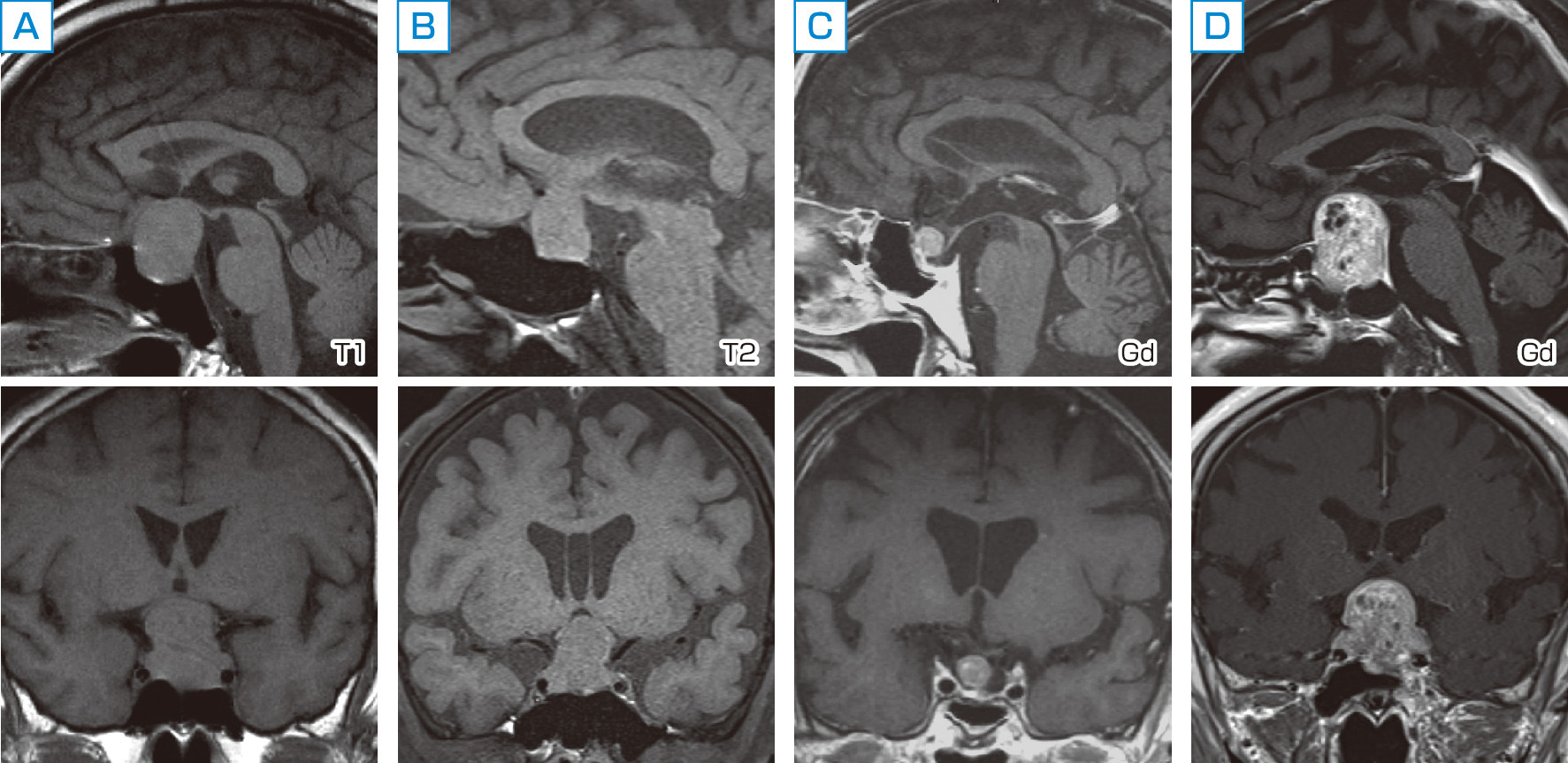ⓔ図15-2-8　ゴナドトロピン産生腺腫の画像所見 A：50歳代・男性．FSH産生腺腫，頭部MRIで鞍上伸展による視神経への圧迫を伴うマクロ腺腫を検出． B：60歳代・男性．FSH産生腺腫，激しい頭痛のため撮影したMRIにて，鞍上進展を伴うマクロ腺腫を認めた． C：60歳代・男性．FSH産生腺腫，トルコ鞍内に類円形の腫瘍を認めた． D：70歳代・男性．FSH産生腺腫の経蝶形骨洞的手術後，約20年での再増大を認めた．