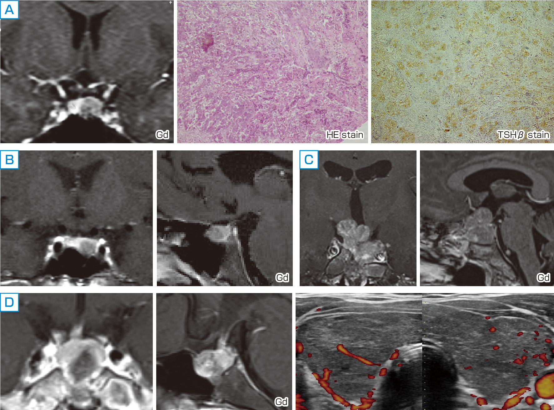 ⓔ図15-2-9　TSH産生腺腫の画像所見と病理所見 A：20歳代・女性．TSH産生腺腫，摘出組織はTSHβ 染色陽性となる腺腫の病理像を呈した． B：50歳代・男性．TSH産生腺腫，下垂体左側にGd造影効果の弱い腫瘍を検出． C：40歳代・男性．TSH/GH同時産生腺腫，手術では線維化が強くかたいマクロ腫瘍を認め，術後残存あり． D：30歳代・女性．TSH産生腺腫，頭痛・倦怠感・動悸にて受診，TSH 6.103 μU/mL，FT3 6.34 pg/mL，FT4 1.76 ng/dLとSITSH所見あり．下垂体MRIで長径＞1 cm大の下垂体腫瘍を検出，甲状腺超音波検査では血流増加を伴うびまん性甲状腺腫を認めた．