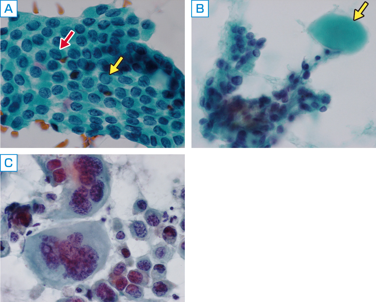 ⓔ図15-4-11　おもな甲状腺腫瘍の典型的細胞像 A：乳頭癌．核内細胞質封入体 (黄矢印) や核の溝 (赤矢印) を認める． B：髄様癌．類円形，紡錘形の細胞を認め，背景にアミロイド物質を認める (黄矢印)． C：未分化癌．大型で高度の異型性を示す腫瘍細胞を認める．