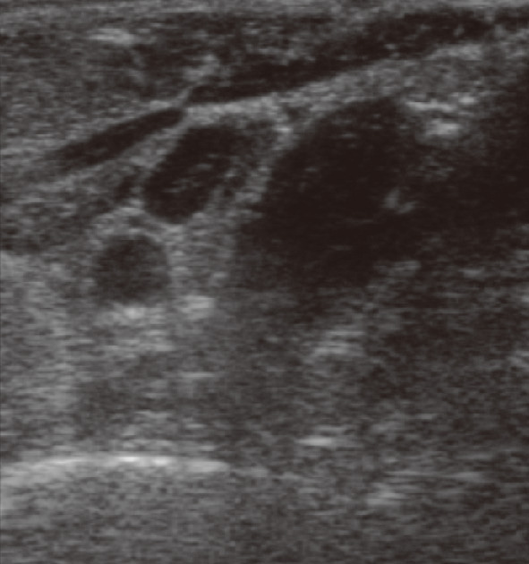 ⓔ図15-4-12　甲状腺左葉内の膿瘍像 