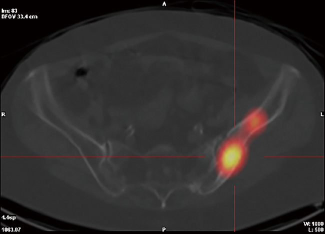 ⓔ図15-4-5　SPECT/CT画像 甲状腺濾胞癌の左腸骨転移による放射性ヨウ素の集積．
