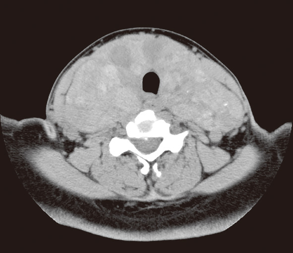ⓔ図15-4-6　頸部CT像 DUOX2遺伝子異常症による巨大甲状腺腫 (甲状腺推定重量：430 g)．