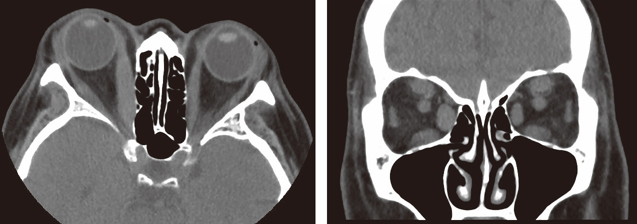 ⓔ図15-4-7　眼窩CT像 甲状腺眼症による突眼と外眼筋の肥大．