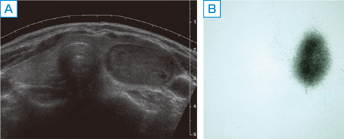 ⓔ図15-4-9　機能性甲状腺結節の画像診断 A：超音波Bモード像．甲状腺左葉に充実性結節を認める．形状は整，境界明瞭で良性結節を思わせる． B：123Iシンチグラフィ像．甲状腺左葉の結節に一致して，集積亢進を認め，周囲の集積は抑制されている．