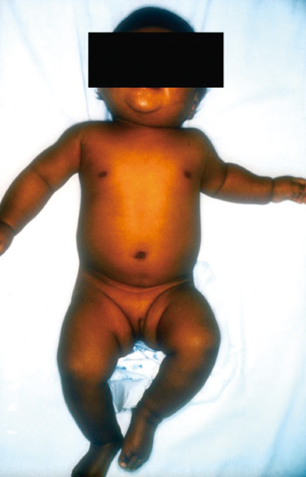 ⓔ図15-6-1　古典型STAR欠損症 46,XY法律上の女児全身像．2カ月時に全身の皮膚色素沈着 (副腎機能低下症によるACTH分泌亢進) で発症した．