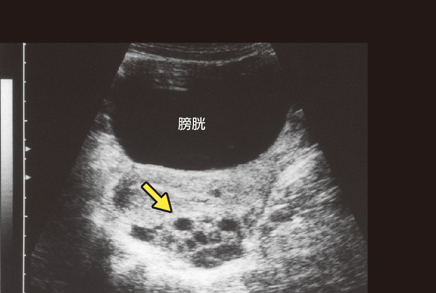 ⓔ図15-6-3　46,XX (20歳) の古典型STAR欠損症卵巣超音波所見 卵巣 (矢印) は多囊胞性卵胞様である．