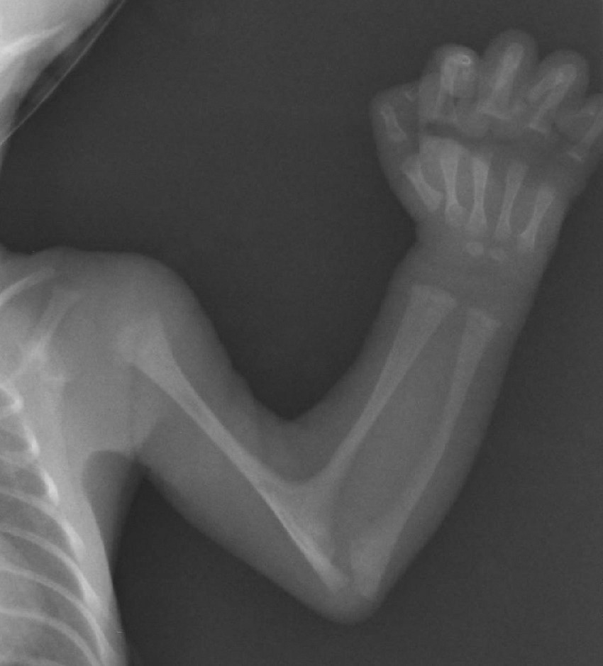 ⓔ図15-6-8　PORD 46,XY新生児の上肢骨X線画像 上腕骨と橈骨は肘関節部位で癒合している．