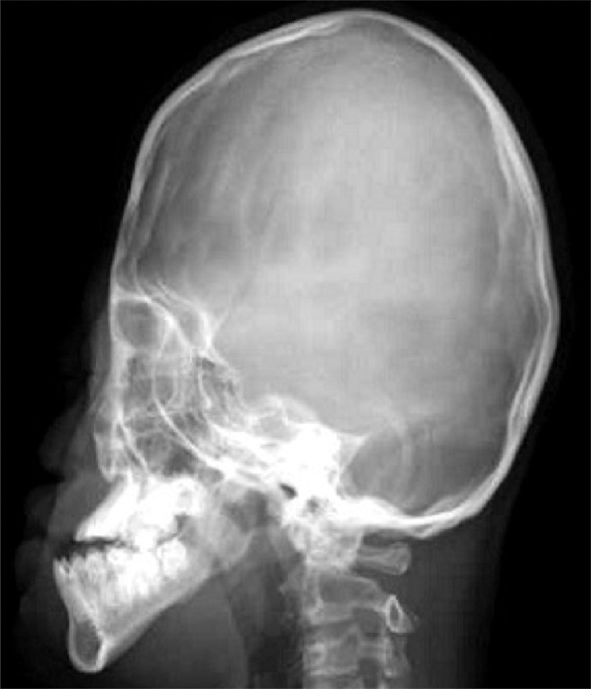 ⓔ図15-6-9　PORD 46,XY13歳の頭蓋骨X線画像 無治療頭蓋骨早期癒合症のため頭蓋前後径は短い (短頭；brachycephaly)．