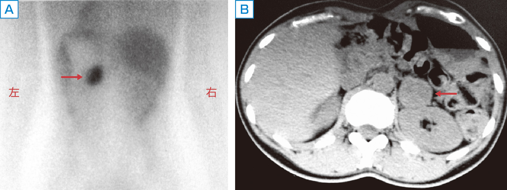 ⓔ図15-7-2　123I–MIBGシンチグラフィ (A) で左副腎褐色細胞腫 (B) に一致した集積を認める 