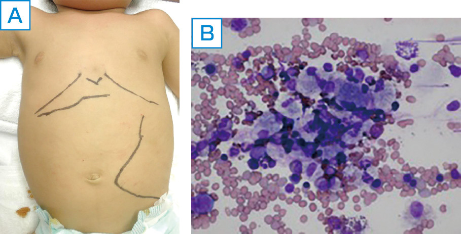 ⓔ図16-6-3　Gaucher病 肝脾腫． A：Gaucher病Ⅱ型１歳の診断時の腹部所見． B：Gaucher細胞．