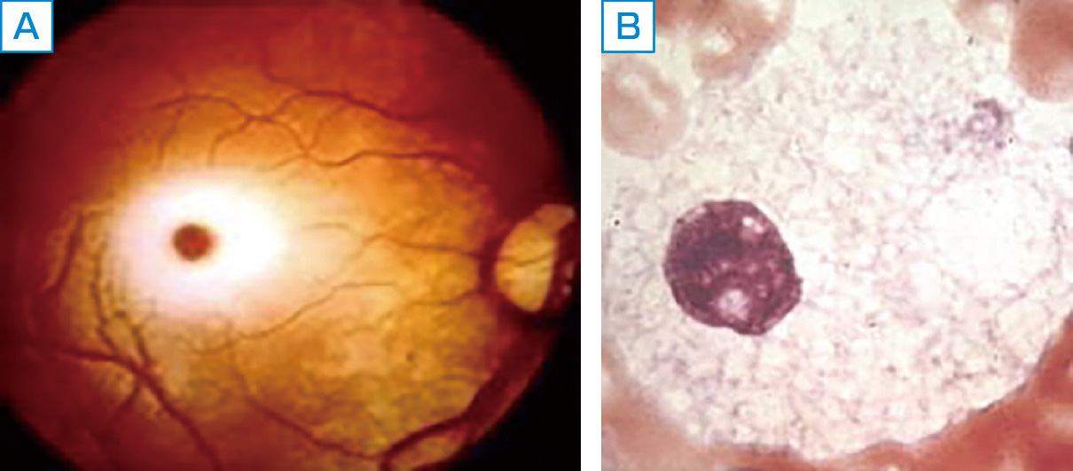 ⓔ図16-6-4　Niemann–Pick病A/B型 A：チェリーレッドスポット． B：Niemann–Pick細胞．