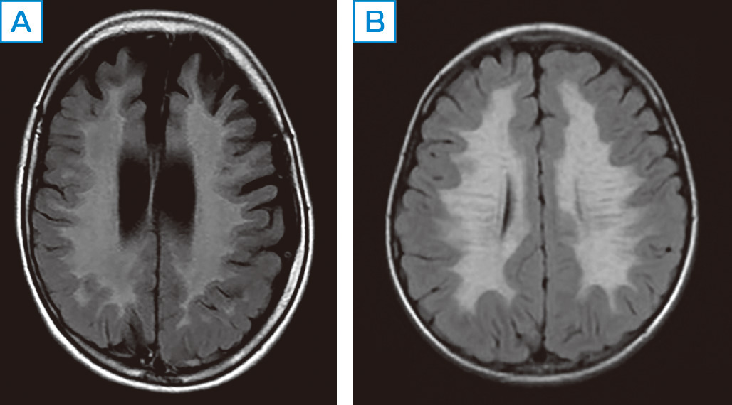 ⓔ図16-6-6　異染性白質ジストロフィー A：後期乳児型MLD (MRI FLAIR画像)． B：若年型MLD (MRI FLAIR画像)．矢印部分にみえる横筋がtiger stripe．