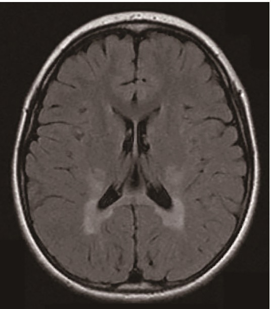 ⓔ図16-6-7　Krabbe病 (MRI FLAIR画像) 脳室後角の白質高輝度領域．