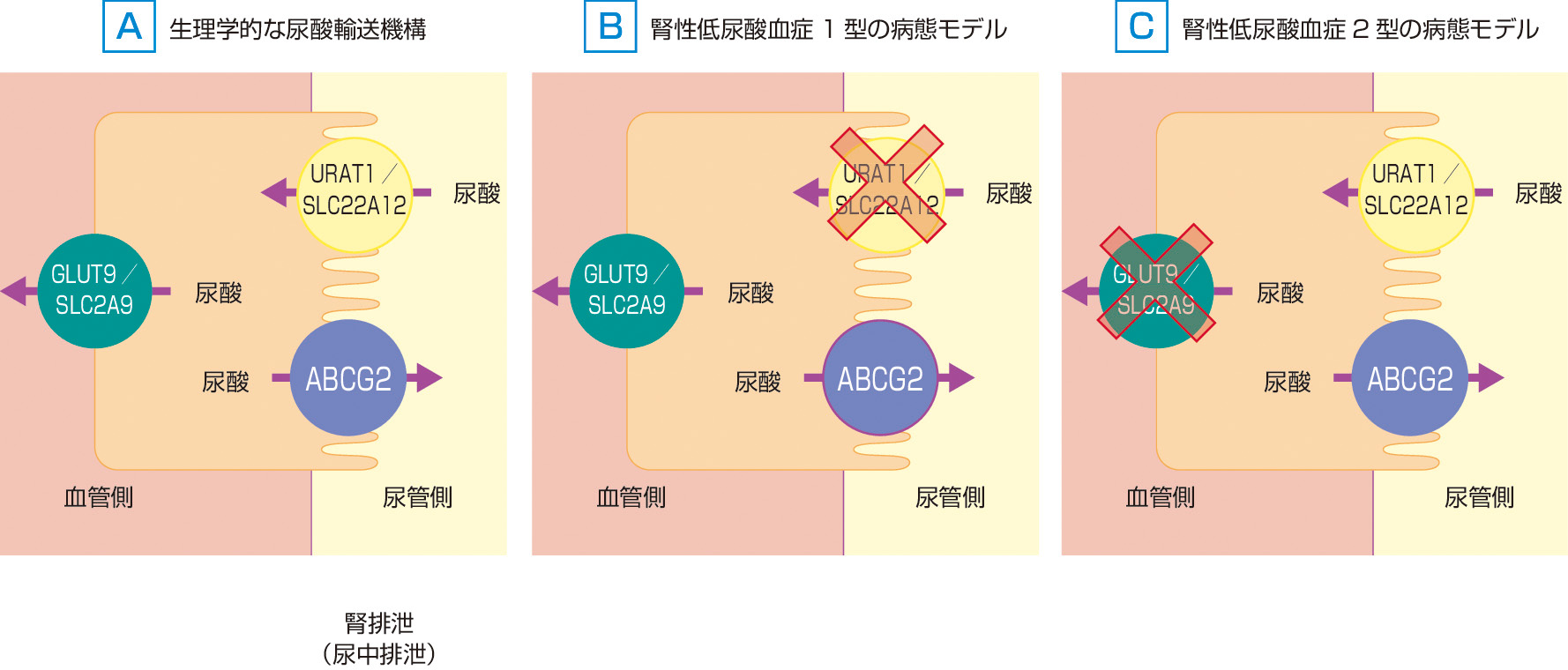 ⓔ図16-7-6　腎性低尿酸血症のメカニズム (腎性低尿酸血症診療ガイドラインより作成) 