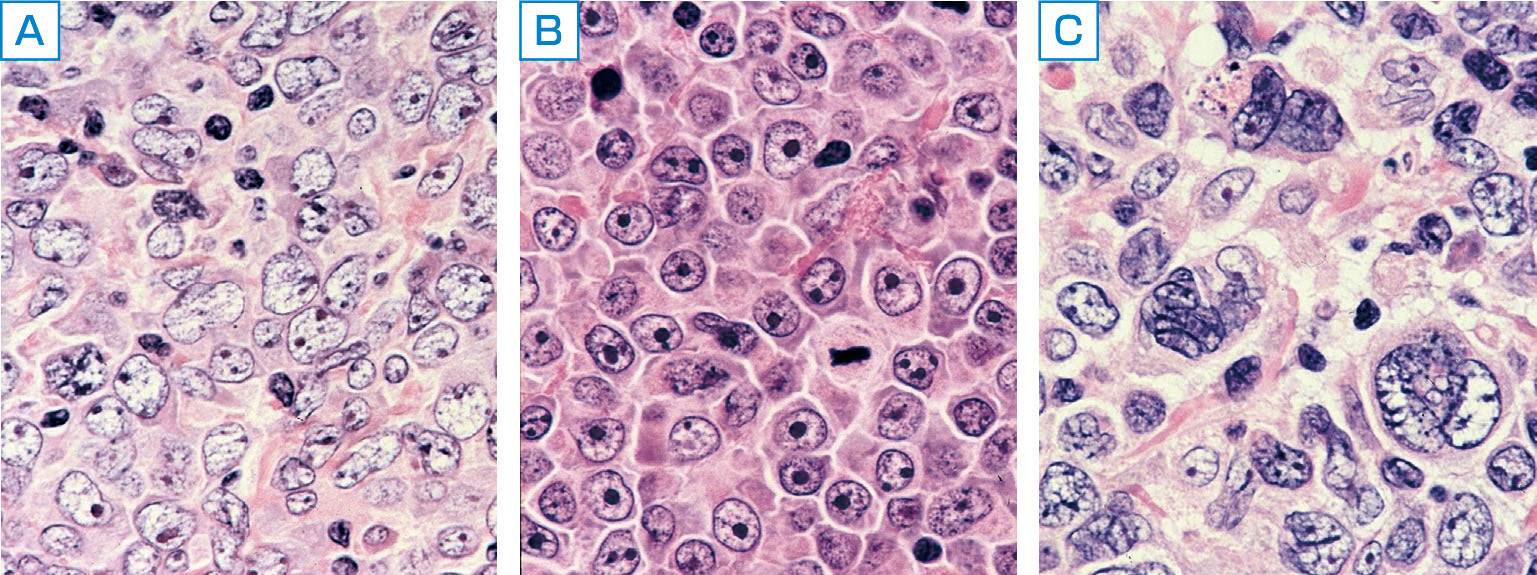 ⓔ図17-10-10　びまん性大細胞型B細胞リンパ腫 (DLBCL) の病理組織像 (中村栄男先生のご厚意による) DLBCLは病理組織学的にも不均一な疾患である．左からcentroblastic variant, immunoblastic variant, anaplastic variant.