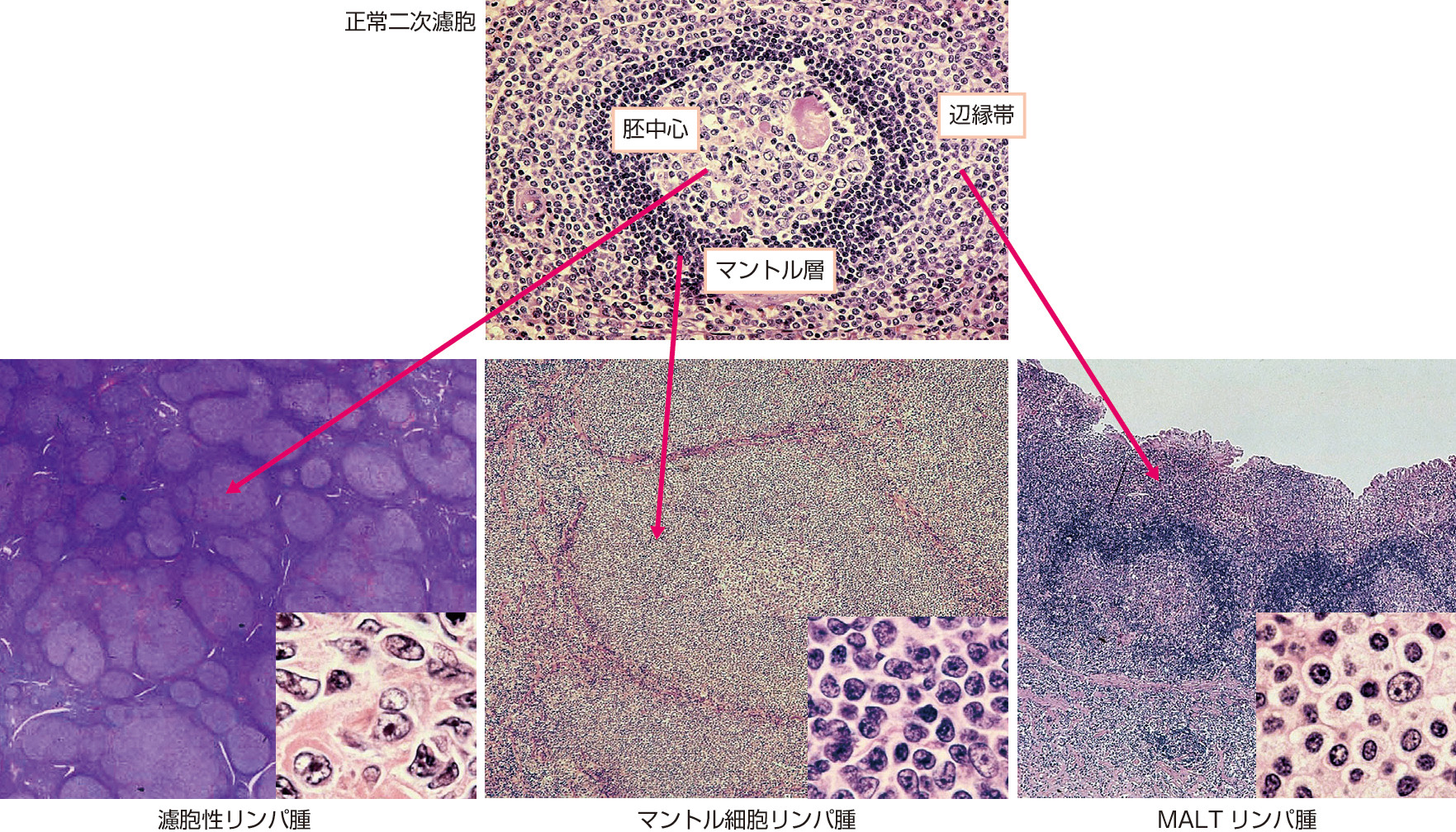ⓔ図17-10-11　濾胞性リンパ腫，マントル細胞リンパ腫，MALTリンパ腫の病理組織像 (写真はすべて中村栄男先生のご厚意による) 各リンパ腫の腫瘍細胞の形態と浸潤パターンは，それぞれの正常由来細胞と類似している．