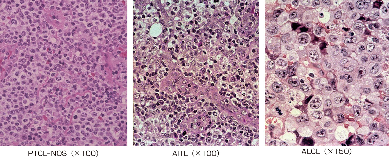 ⓔ図17-10-12　PTCL–NOS, AITL, ALCLの病理組織像 (写真はすべて中村栄男先生のご厚意による) PTCL–NOS: pheripheral T–cell lymphoma, not otherwise specified，末梢性T細胞リンパ腫・非特定型． AITL: angioimmunoblastic T–cell lymphoma，血管免疫芽球性T細胞リンパ腫． ALCL: anaplastic large cell lymphoma，未分化大細胞リンパ腫．