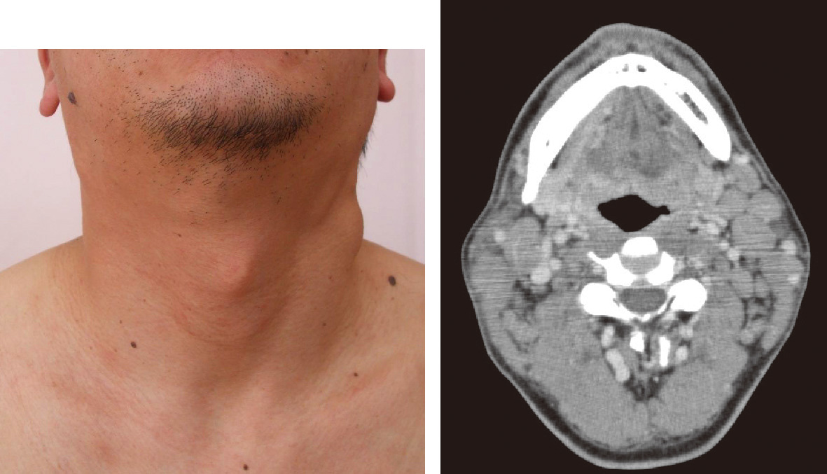 ⓔ図17-10-15　ATL患者のリンパ腫 (肉眼所見とCT画像) 