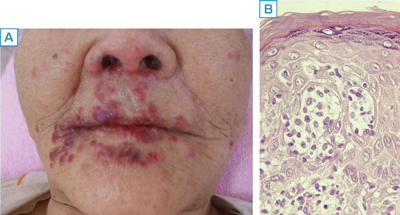 ⓔ図17-10-16　慢性型ATL患者の皮膚病変 A：顔面皮膚から口唇に癒合傾向のある紅丘疹から腫瘤を認める． B：組織学的には核異型のあるATL細胞の表皮好性の増生をみとめる (HE染色×400)．