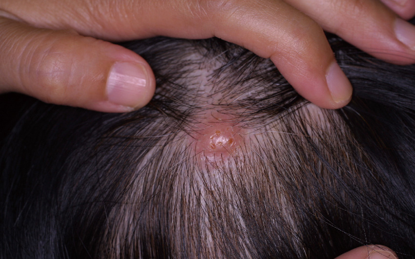 ⓔ図17-10-17　頭皮に認められた病変 