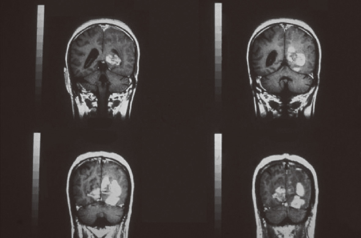 ⓔ図17-10-18　ATL細胞の中枢神経への浸潤 