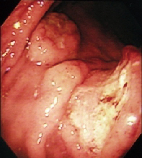 ⓔ図17-10-19　ATL胃病変 