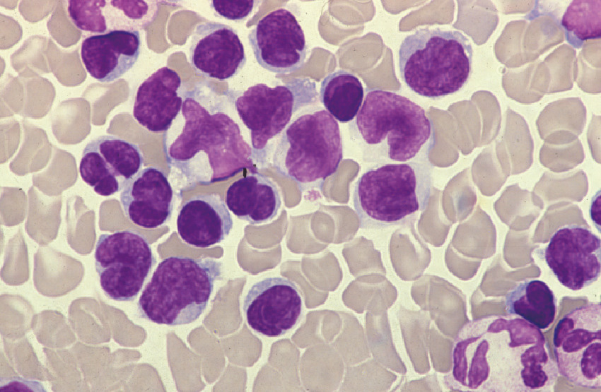 ⓔ図17-10-20　白血球数が著増した典型的なATL症例 小型からやや大型までのprototype，intermediate，CLL–like細胞を認める (急性型，末梢血，original mag，×1000)．