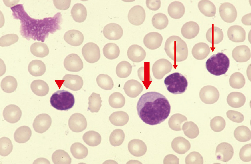 ⓔ図17-10-21　典型的なATL症例 小型のprototype細胞 (細矢印)，やや大型のprototype細胞 (太矢印) とintermediate細胞 (矢印頭) (急性型，末梢血，original mag，×1000)．