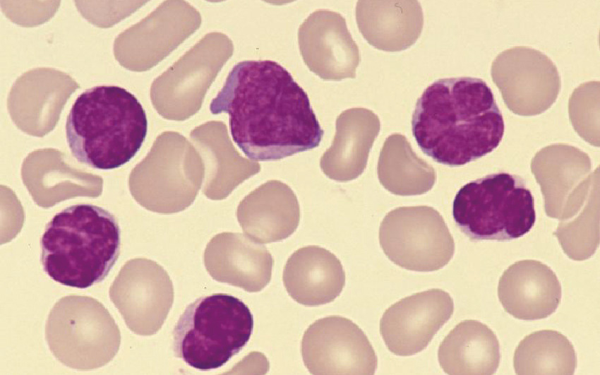 ⓔ図17-10-22　典型的なATL症例 大型のprototype細胞が主体である (急性型，末梢血，original mag，×1000)．