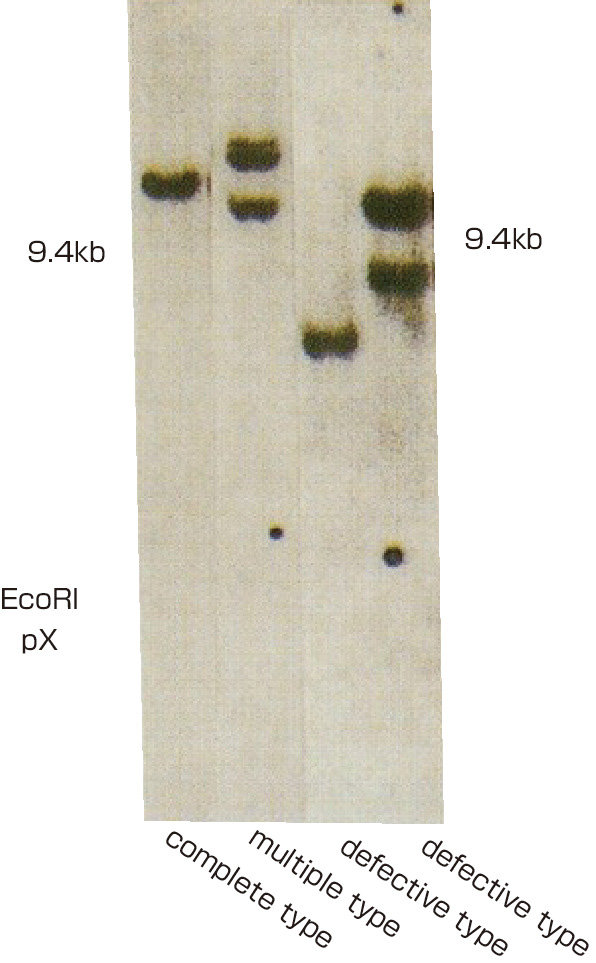 ⓔ図17-10-23　サザンブロット法によるATL細胞へのHTLV–1プロウイルスの単クローン性組み込み (complete type: 完全型，multiple type: 多重型，defective type: 欠損型) HTLV–1プロウイルスのPx領域をプローブとして用い，ATL細胞から抽出した高分子DNAを約9kbのHTLV–1内に切断点をもたない制限酵素EcoRIで処理した．ATL細胞におけるHTLV–1の単クローン性組み込みは，完全型，多重型，欠損型に分類できる．