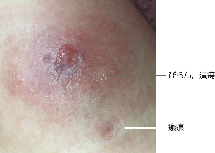 ⓔ図17-10-25　蚊刺過敏症皮膚病変 