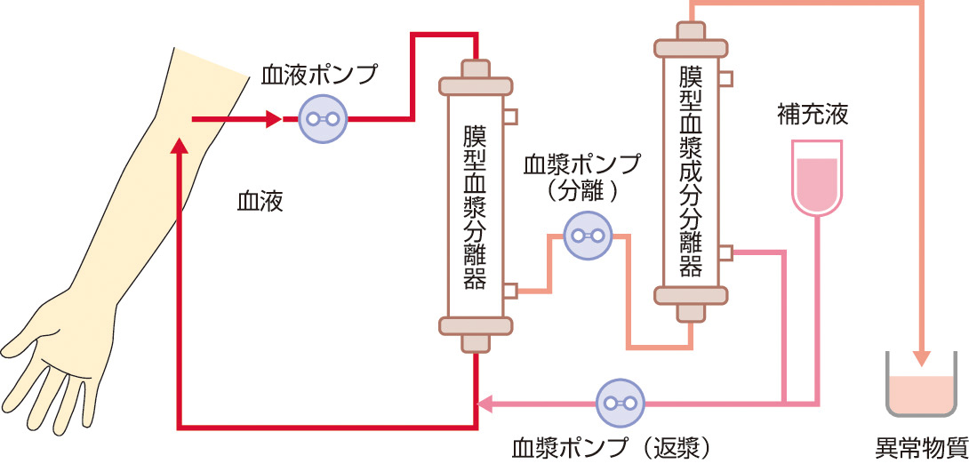 ⓔ図17-10-28　二重膜濾過血漿交換 