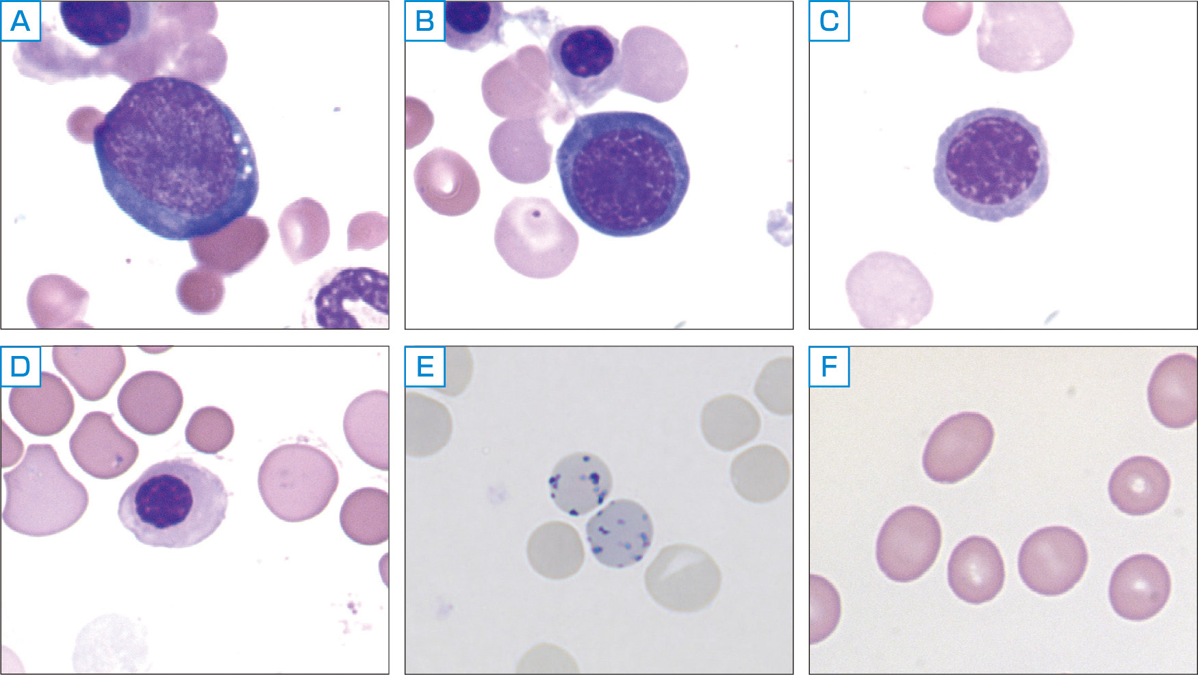 ⓔ図17-3-2　赤芽球，網赤血球，赤血球の形態 前赤芽球 (A) は直径が20～25 µmで核小体が明瞭で塩基性が強い．好塩基性赤芽球 (B) は直径が16～18 µmとやや小型で細胞質はやや塩基性，核小体はやや不明瞭になる．多染性赤芽球 (C) は直径が12～15 µm，細胞質の青みが減少し，ヘモグロビンが増加するため赤味が増す．正染性赤芽球 (D) は，直径10～15 µm，細胞質の色調は赤血球と同様で，核網はより濃縮している．網赤血球 (E) は，残存したリボソームが青色網状に染まる．赤血球の85％がヘモグロビンである．