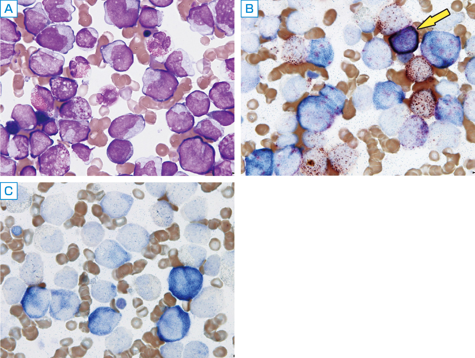 ⓔ図17-5-2　好酸球増加を伴う急性骨髄単球性白血病症例 (AMMoL with eosinophilia) の染色所見 (A～Cは同一症例・同一時期の標本) A：May–Grünwald–Giemsa染色．骨髄系もしくは単球系と思われる幼若細胞に加えて，異常顆粒を有する好酸球が認められる． B：Es二重染色．細胞質が青くにじんだように染まるのが特異的Esで，好中球系細胞が染色される．茶色で斑状に染まるのが非特異的Esで，特に単球系では非特異的Esが染色される．矢印の細胞は両エステラーゼ陽性の細胞である． C：Es二重染色・フッ化ナトリウム処理後．単球系細胞の非特異的Es染色が阻害されている．