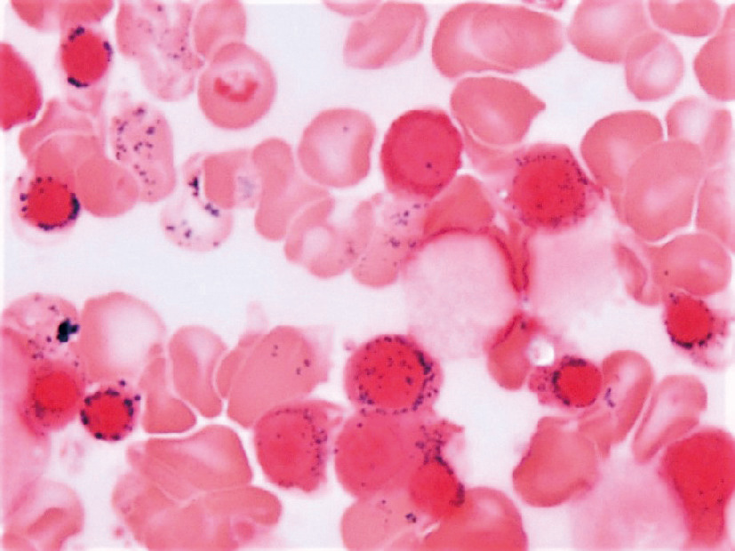 ⓔ図17-5-3　鉄染色 MDS–RS病型である．核周囲に濃青色の鉄染色陽性顆粒が散在する環状鉄芽球が随所にみられる．