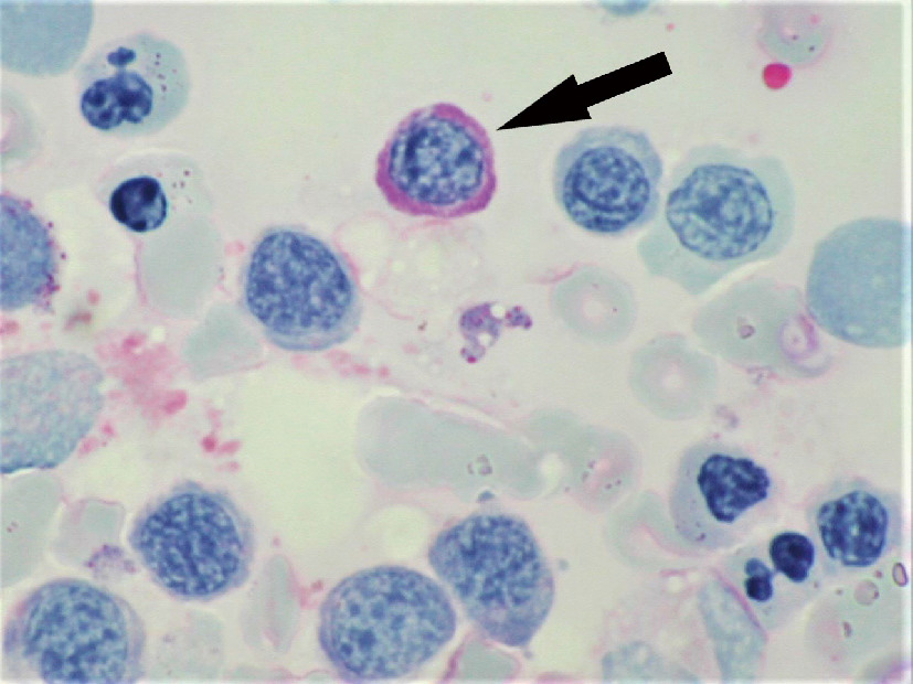 ⓔ図17-5-5　PAS染色陽性の異常赤芽球 (矢印) MDS症例で，頻度は少ないが赤芽球の異形成所見の1つとされている．矢印以外の赤芽球はPAS陰性である．