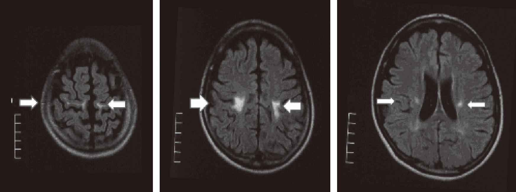 ⓔ図18-10-1　Krabbe病の頭部MRI (FLAIR画像) 両側錐体路に高信号を認め，中心前回まで広がる病変が特徴的である (矢印)．