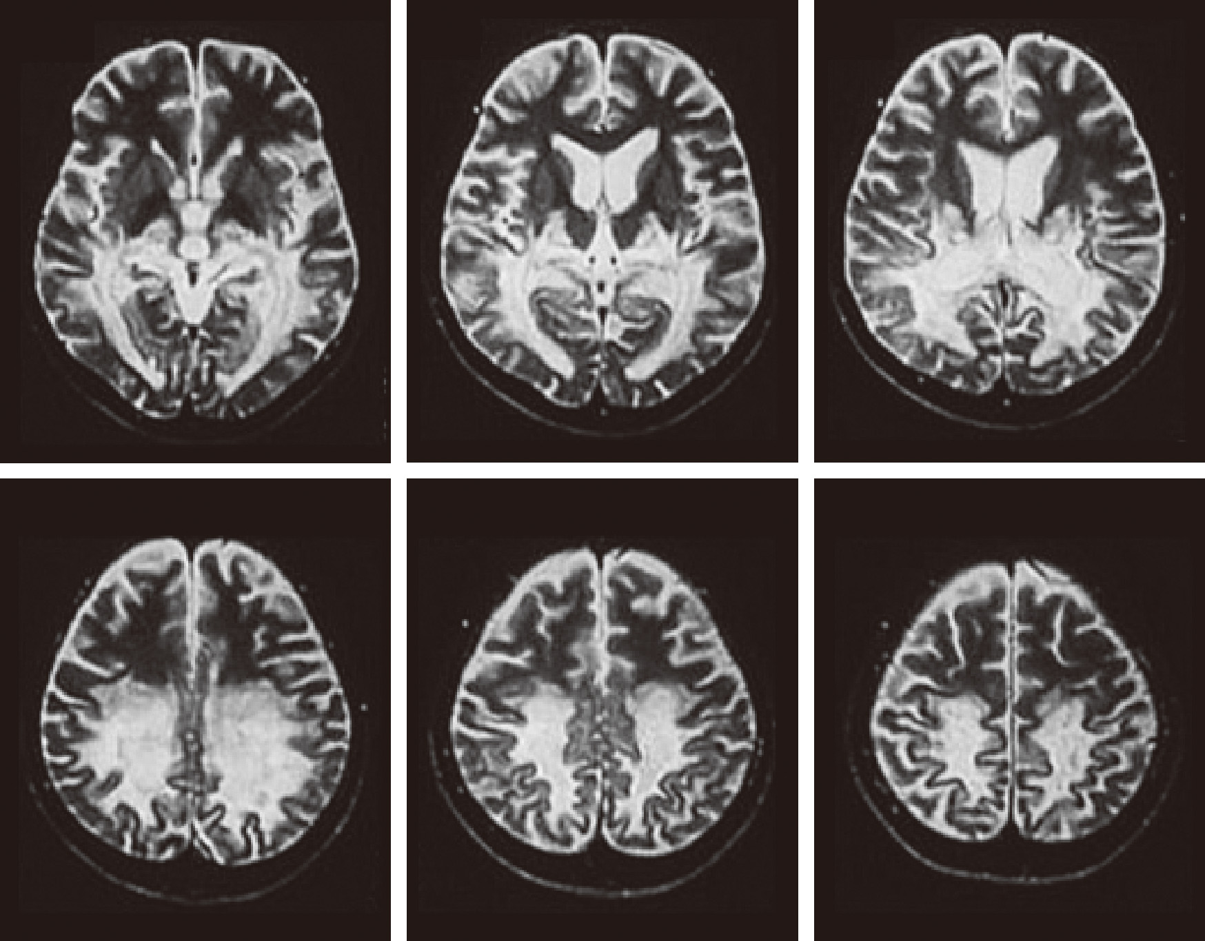 ⓔ図18-10-2　副腎白質ジストロフィーの頭部MRI (T2強調画像) 側脳室三角部周辺，脳梁を中心として広範囲に左右対称性の高信号域 (脱髄病変) が認められる．