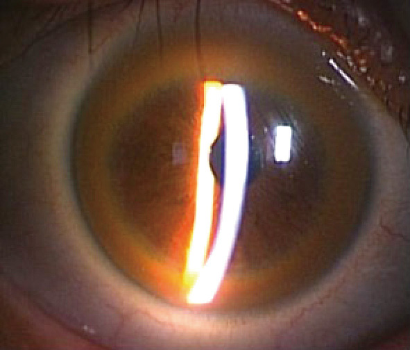 ⓔ図18-10-3　Kayser–Fleischer角膜輪 細隙灯下で観察すると角膜の周辺に黄褐色のリング状の変化を認める．