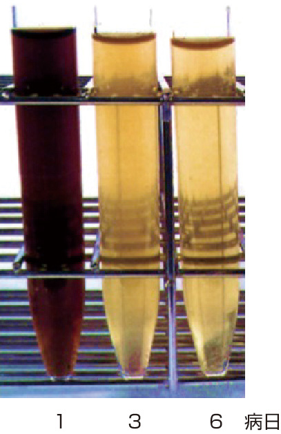 ⓔ図18-10-4　赤濃色尿 発作時には赤濃色の尿を認める．