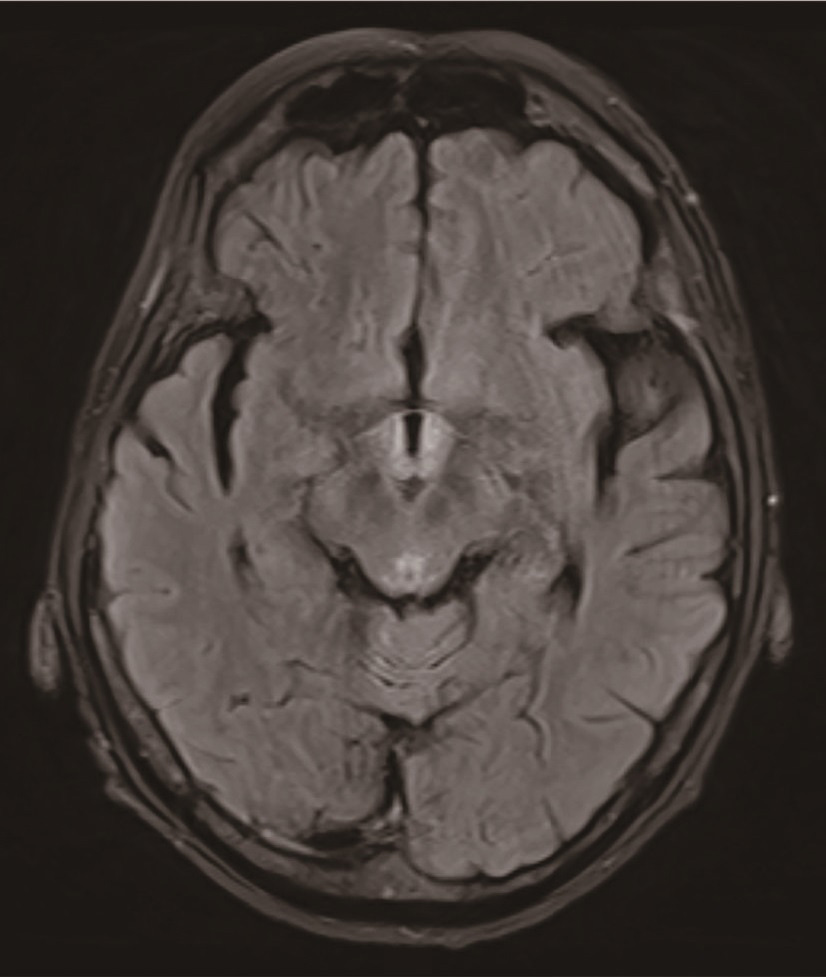 ⓔ図18-11-3　Wernicke脳症のMRI画像 