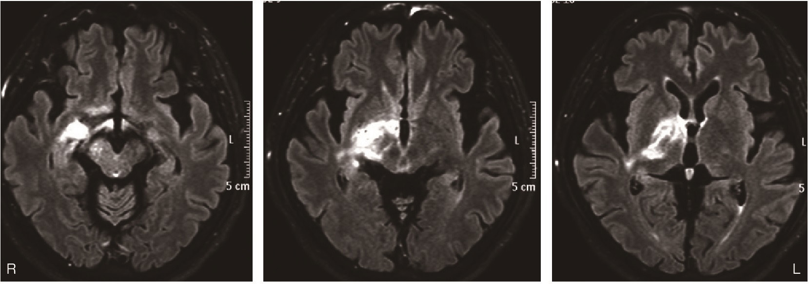 ⓔ図18-12-1　悪性リンパ腫のMRI FLAIR画像 (びまん性型) 
