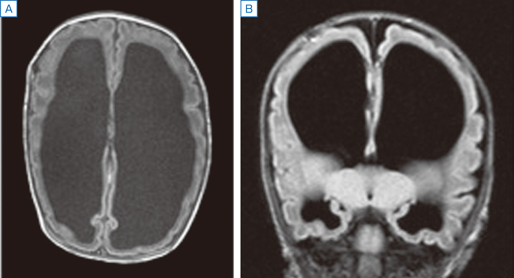 ⓔ図18-13-1　先天性水頭症 MRI T1強調画像．A：水平断，B：冠状断．著明な脳室の拡大と大脳の萎縮を認める．