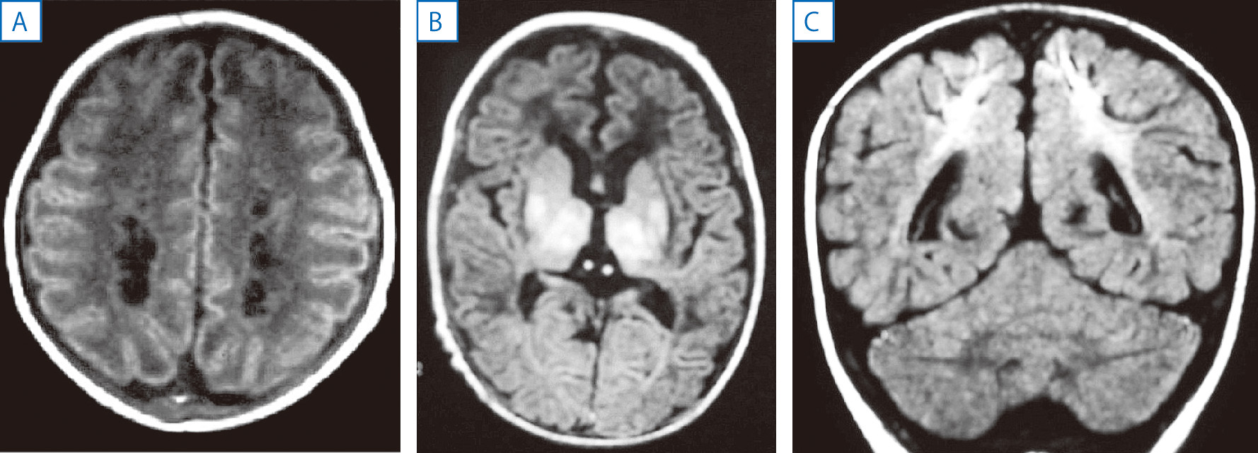 ⓔ図18-13-10　周産期脳障害 A：脳室周囲白質軟化症 (両側性の脳室周囲白質内の嚢胞)，頭部MRI，T1強調画像，水平断，B：基底核視床壊死，頭部MRI，FLAIR水平断 (埼玉県立小児医療センター小熊栄二先生提供)，C：傍矢状脳障害，頭部MRI，FLAIR冠状断．